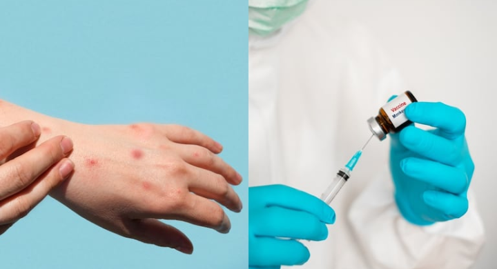 La viruela del mono llega a la Patagonia: Información clave