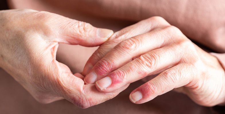Esclerodermia: que es y porque es importante detectarla tiempo 