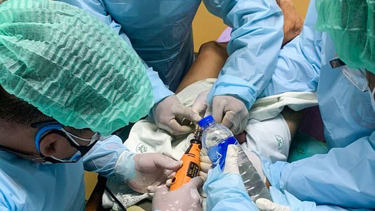 Drogado: Un joven murió tras sellar sus genitales con un fuerte adhesivo para evitar embarazar a su novia