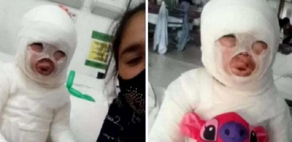 Florencio Varela: una empleada de un restaurante le volcó aceite hirviendo a una nena de 3 años