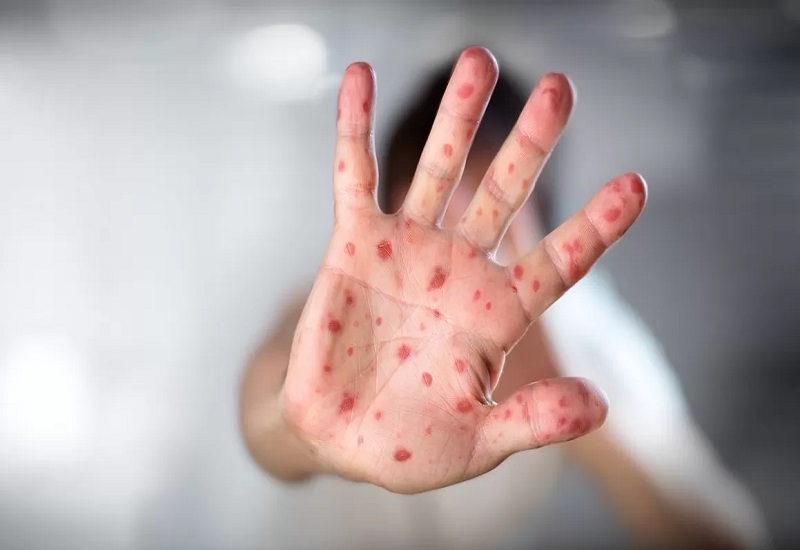 El paciente con viruela símica y el segundo caso sospechoso siguen aislados