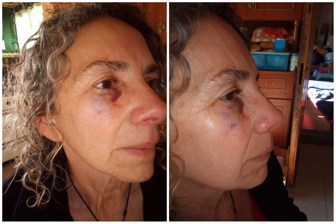 Un hombre alcoholizado la golpeó en la cara cuando ella iba a trabajar