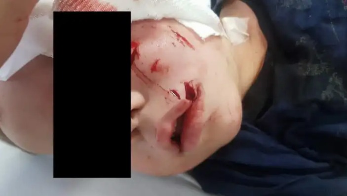 Pico Truncado: un pitbull atacó a un niño de 4 años 