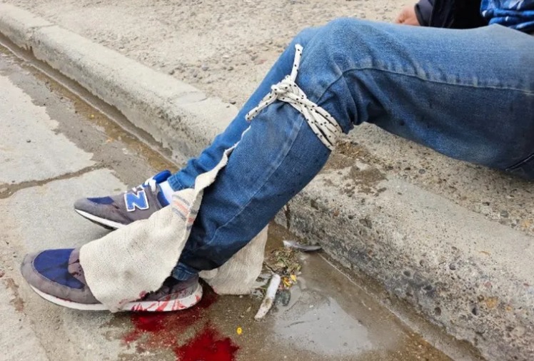 Comodoro Rivadavia: lo balearon en una pierna y no quiso denunciar la agresión