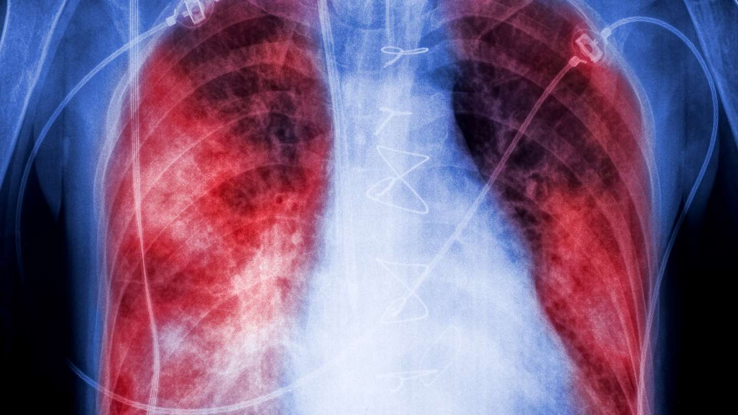 Qué es la neumonía bilateral y qué produce en el cuerpo
