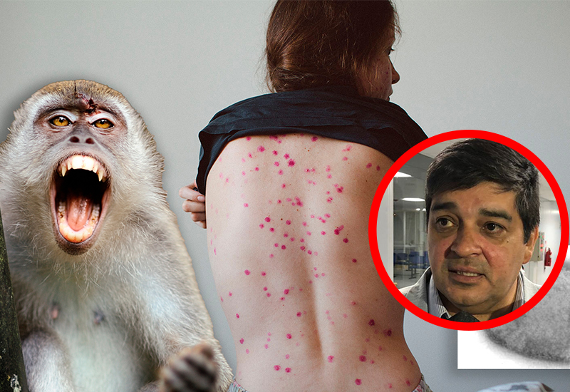 Caleta Olivia podría tener un caso de viruela del mono