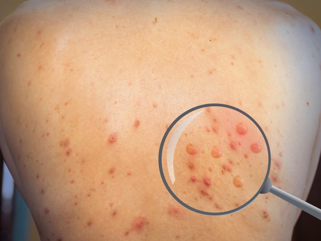 Viruela del Mono: Dio negativo el caso sospechoso estudiado en Caleta Olivia