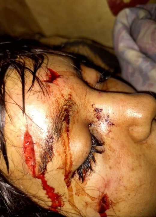Brutal golpiza a una joven de Comodoro: la desfiguraron y está en terapia